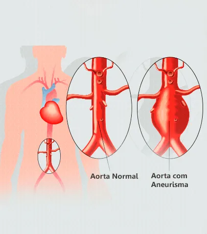 Doenças da Aorta