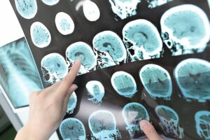 que é uma condição grave e que precisa ser identificada e tratada rapidamente pa