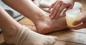 Calcanhares rachados: uma rotina noturna simples pode prevenir dores e recuperar a pele antes do verão