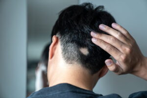 tanto, também é frequente a perda repentina de cabelos e/ou pelos deixando áreas