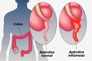 ção do intestino grosso que fica na parte inferior direita do abdômen, podendo c