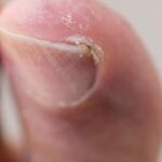 Unha encravada: o corte incorreto e as três causas que você precisa conhecer