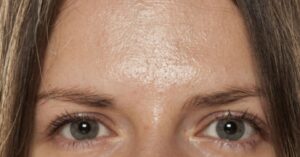 Micropigmentação em pele oleosa: o que considerar antes de optar pelo efeito shadow
