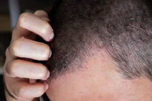 Dermatite: entenda as causas, os principais tipos e como buscar o tratamento adequado
