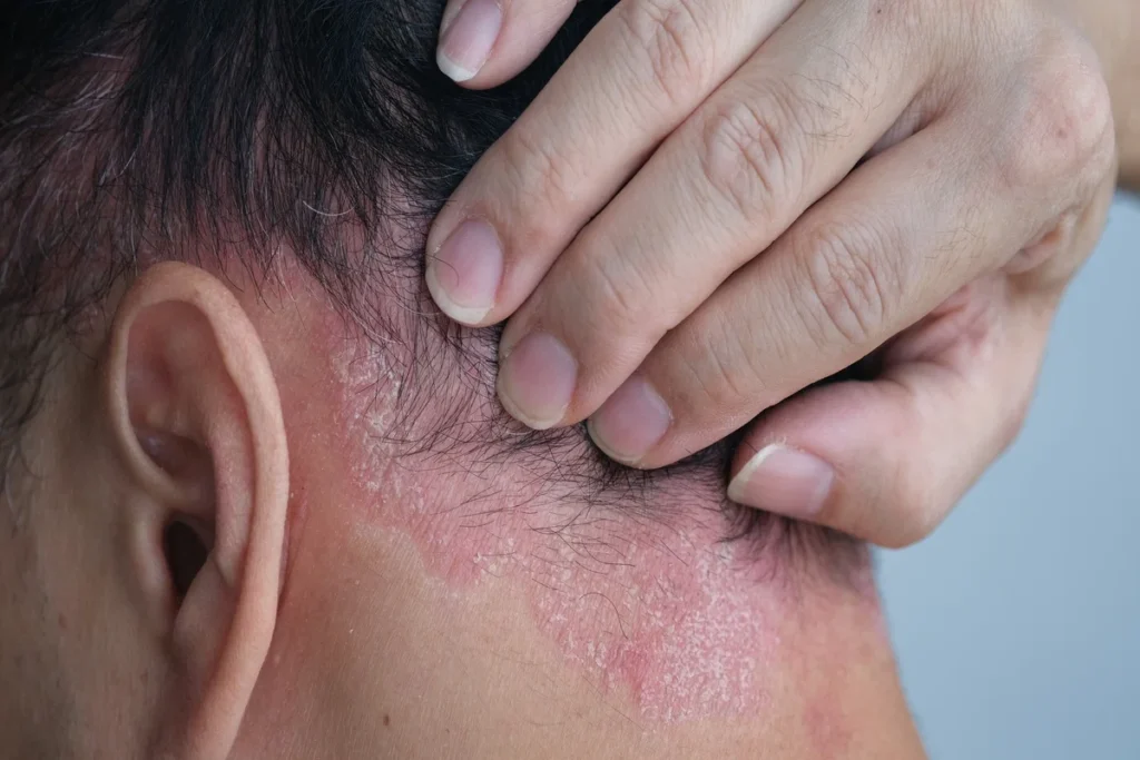 Dermatite seborreica: entenda as causas, sintomas e como controlar a inflamação