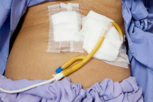 Gastrostomia: entenda o procedimento, indicações e cuidados essenciais