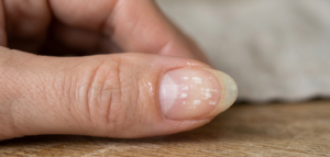 Manchas brancas nas unhas: desvende as causas e saiba quando buscar tratamento