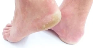 Pés ressecados e com rachaduras: 6 opções de cremes para restaurar a hidratação da pele