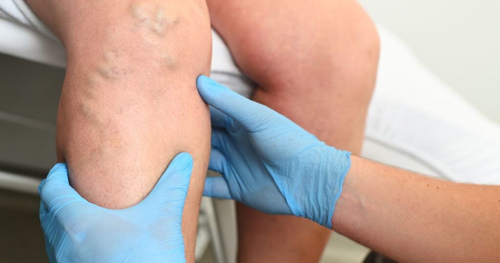 Sete sintomas nas pernas que exigem atenção médica para evitar problemas vasculares graves