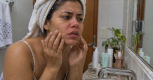 Cuidados com a pele: mistura caseira viral causa irritação e alerta para riscos de receitas sem orientação