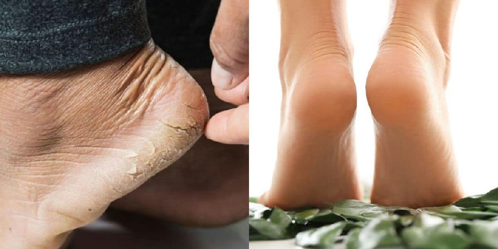 Cuidados com os pés: como a vaselina ajuda a combater calcanhares rachados