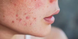 Guia prático ajuda a tratar a acne e prevenir cicatrizes permanentes no rosto