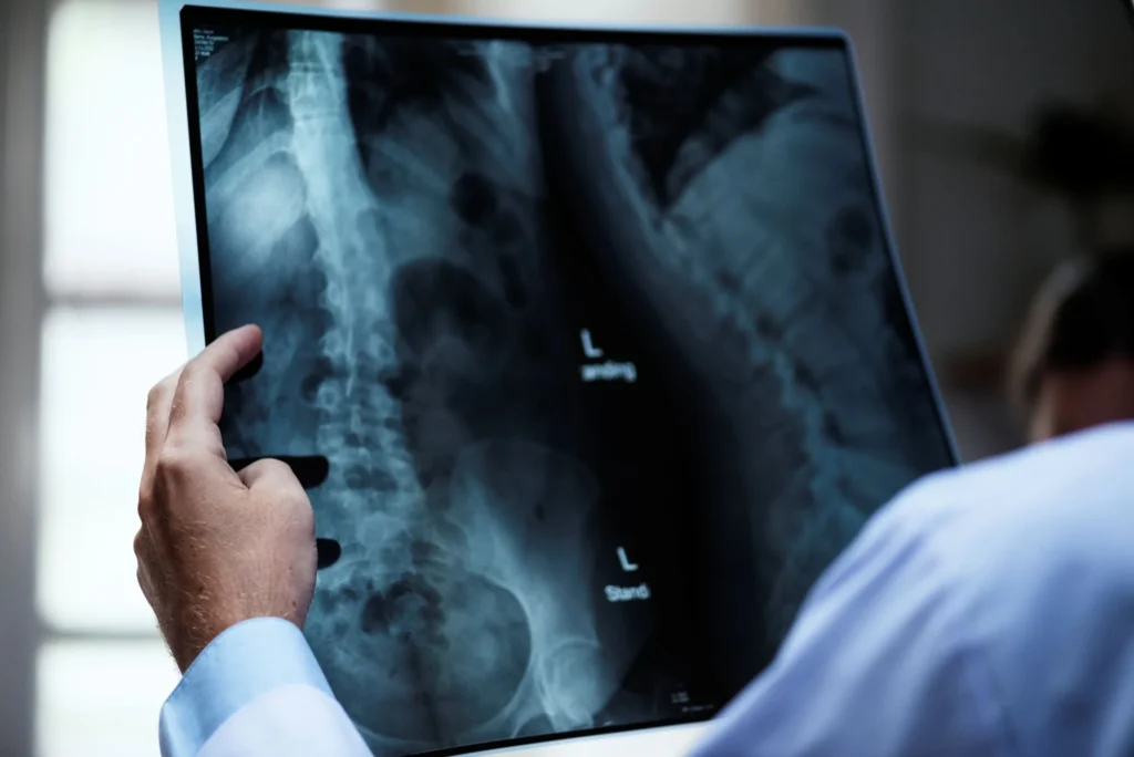 Osteoporose: entenda como a doença afeta homens e mulheres de formas distintas