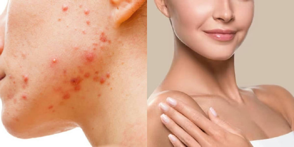 Sérum facial busca controle da acne e uniformização da pele com ativos combinados