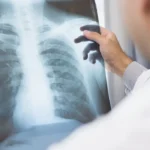 Anvisa aprova novos medicamentos para tratamento de câncer de pulmão e mama