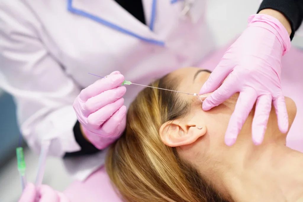 Como funcionam os fios de PDO na estética facial e corporal