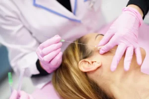 Como funcionam os fios de PDO na estética facial e corporal