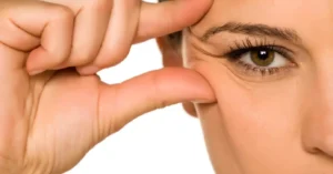 Quatro procedimentos dermatológicos ajudam a suavizar rugas ao redor dos olhos