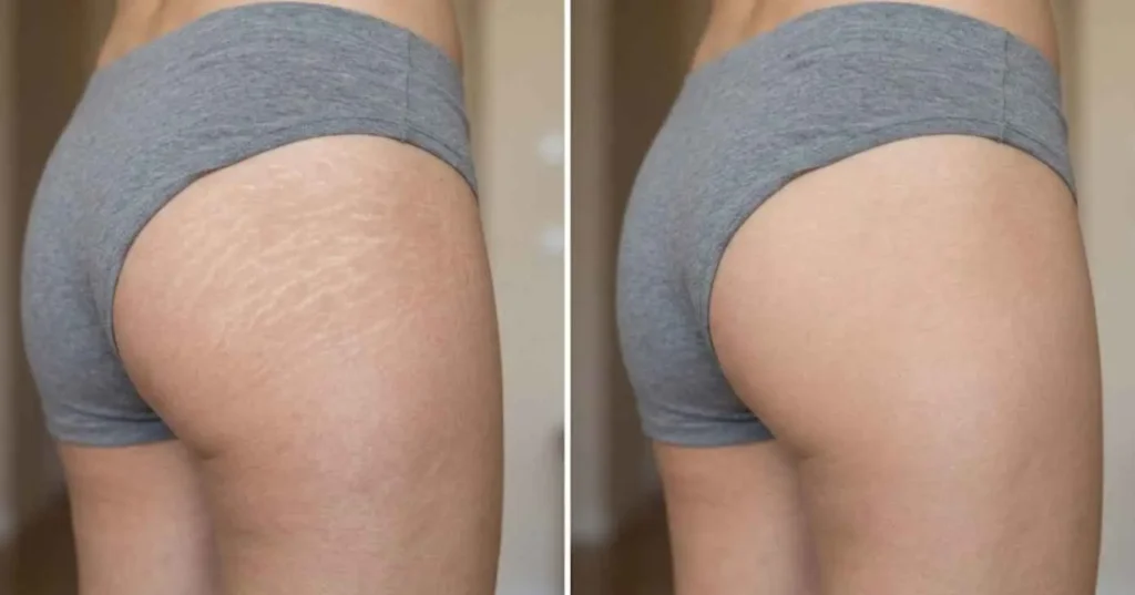 Três cosméticos essenciais para melhorar a hidratação e suavizar estrias na pele