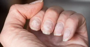 Unhas descamando: entenda as causas e como recuperar a saúde das mãos
