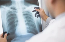 Anvisa aprova novos medicamentos para tratamento de câncer de pulmão e mama