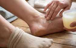 Calcanhares rachados: uma rotina noturna simples pode prevenir dores e recuperar a pele antes do verão