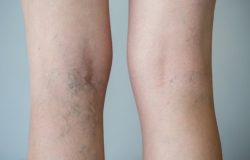 este especialista estão: Varizes e vasinhos; Trombose venosa profunda; Insuficiê