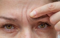 Rugas na testa: 3 segredos para amenizar o problema e rejuvenescer