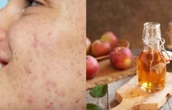 Manchas escuras? Solução caseira com vinagre clareia a pele e ajuda a reduzi-las