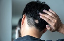 tanto, também é frequente a perda repentina de cabelos e/ou pelos deixando áreas