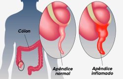 ção do intestino grosso que fica na parte inferior direita do abdômen, podendo c