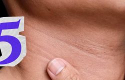 Dermatologista revela 5 dicas essenciais para prevenir e suavizar rugas no pescoço