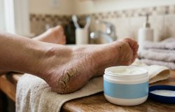 Rachaduras nos pés que não cicatrizam: entenda quando o problema vai além da estética