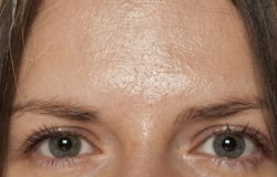 Micropigmentação em pele oleosa: o que considerar antes de optar pelo efeito shadow