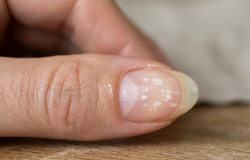 Manchas brancas nas unhas: desvende as causas e saiba quando buscar tratamento