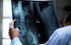 Osteoporose: entenda como a doença afeta homens e mulheres de formas distintas