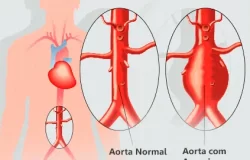 Doenças da Aorta