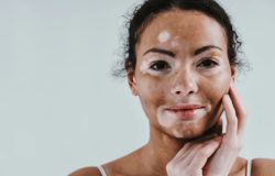 vitiligo