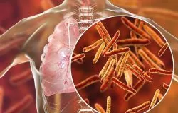 tuberculose
